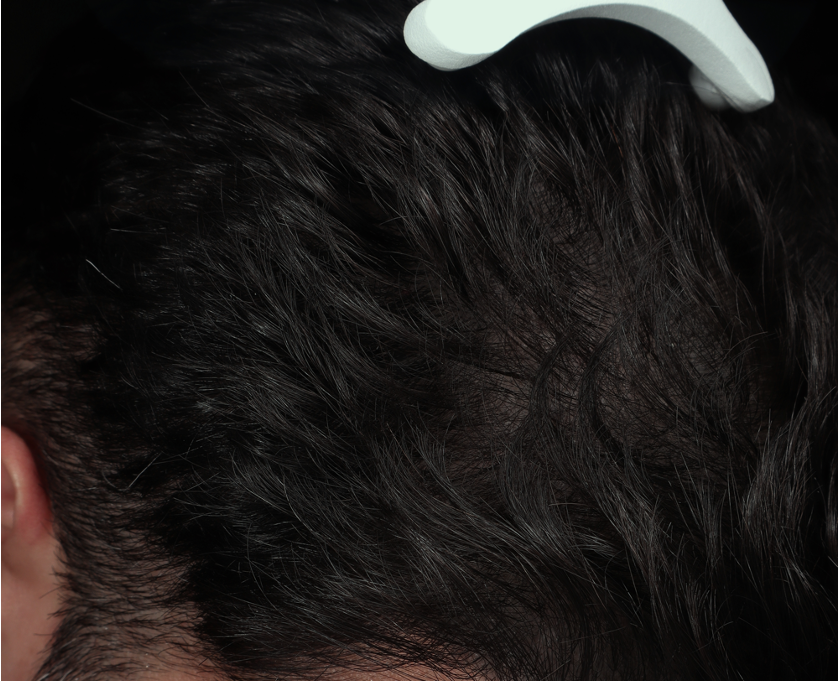 Alopecia androgenetica after