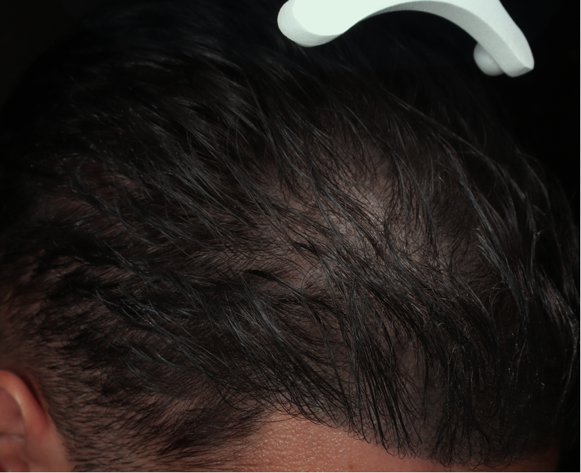 Alopecia androgenetica before