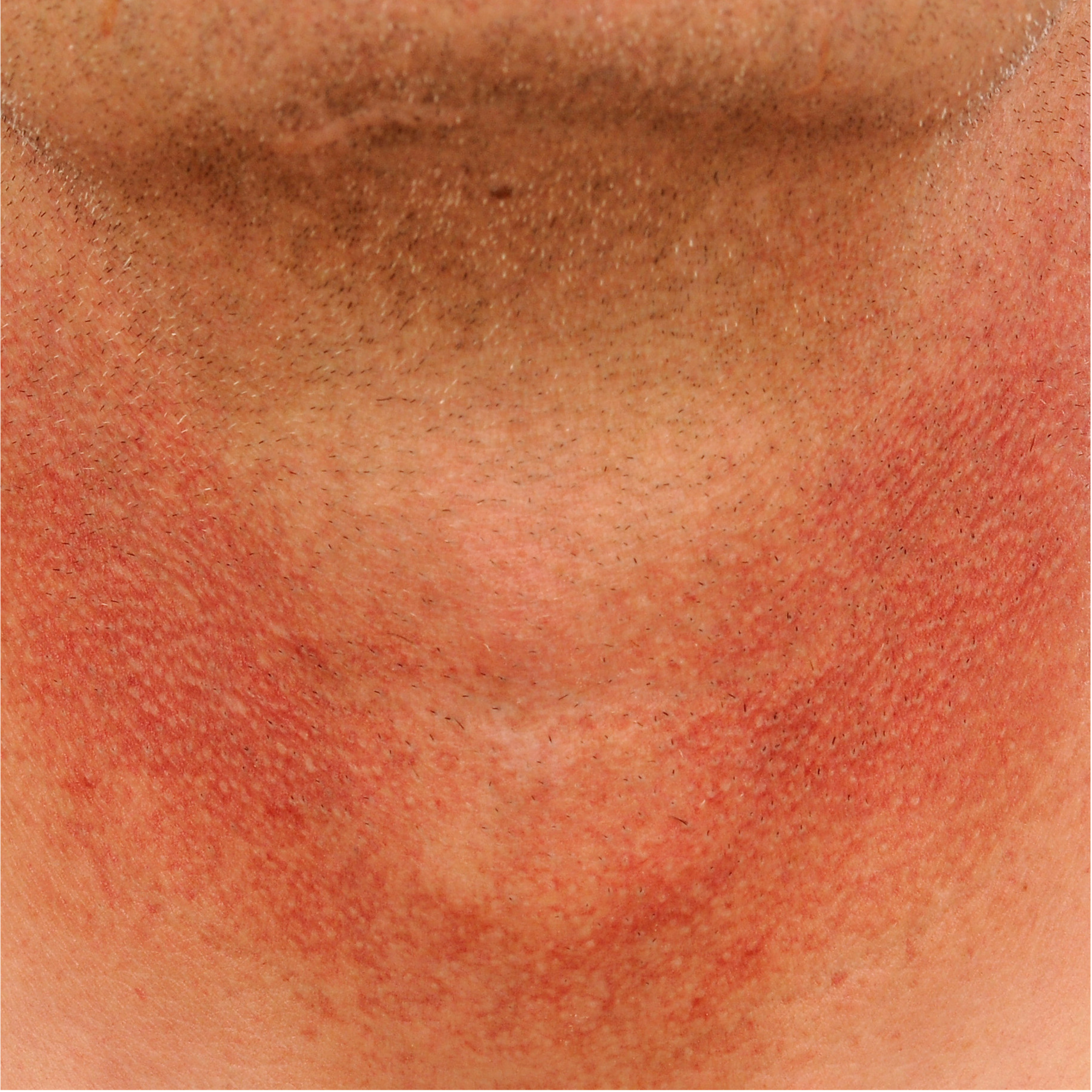 Erythrosis interfollicularis colli 