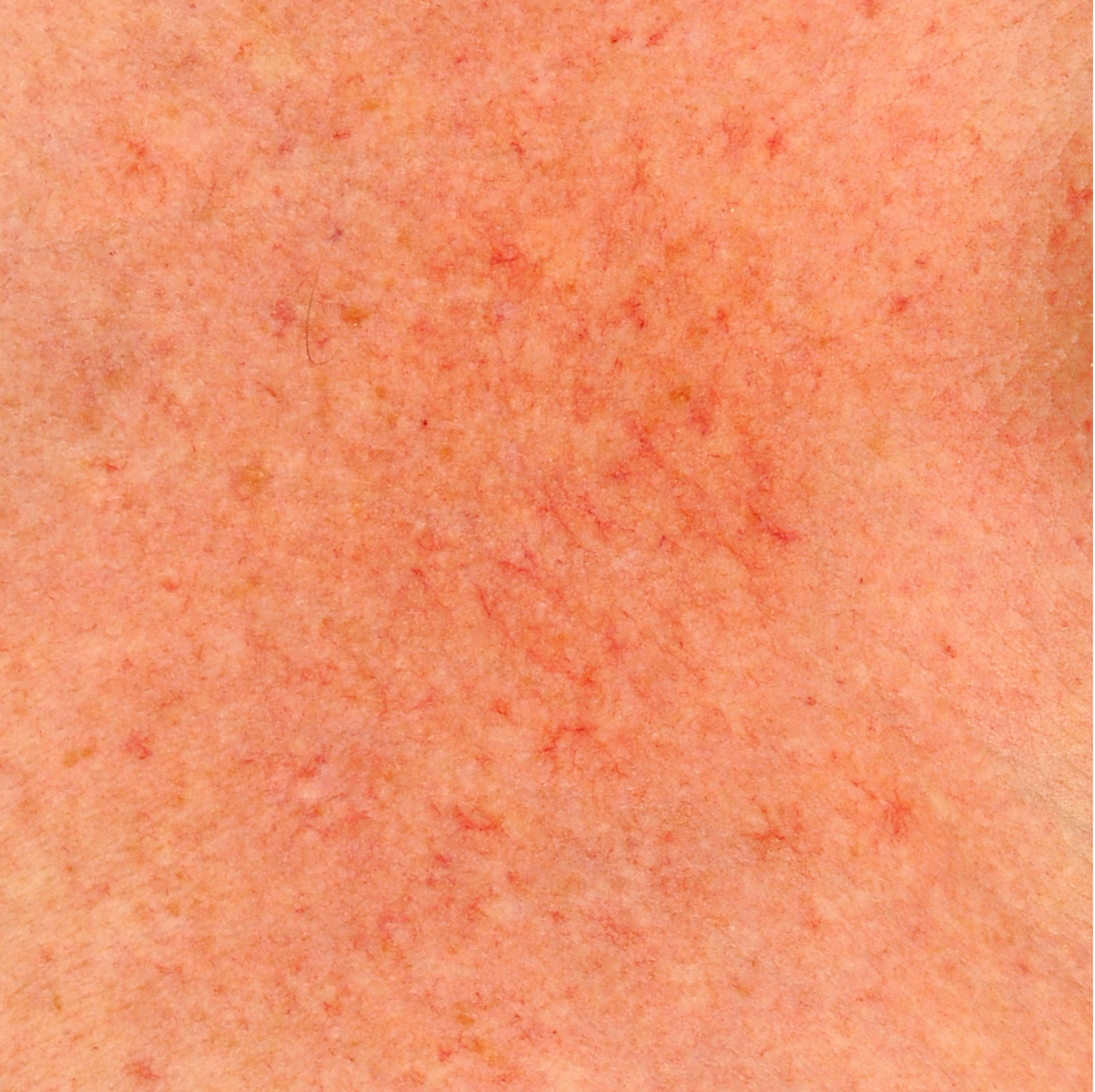 Poikiloderma