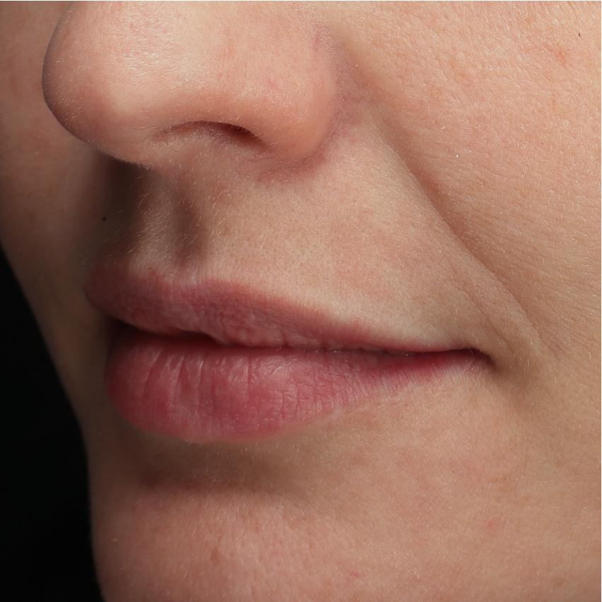 Neuslippenplooi voor behandeling