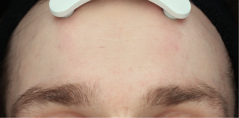 Acne - na behandeling