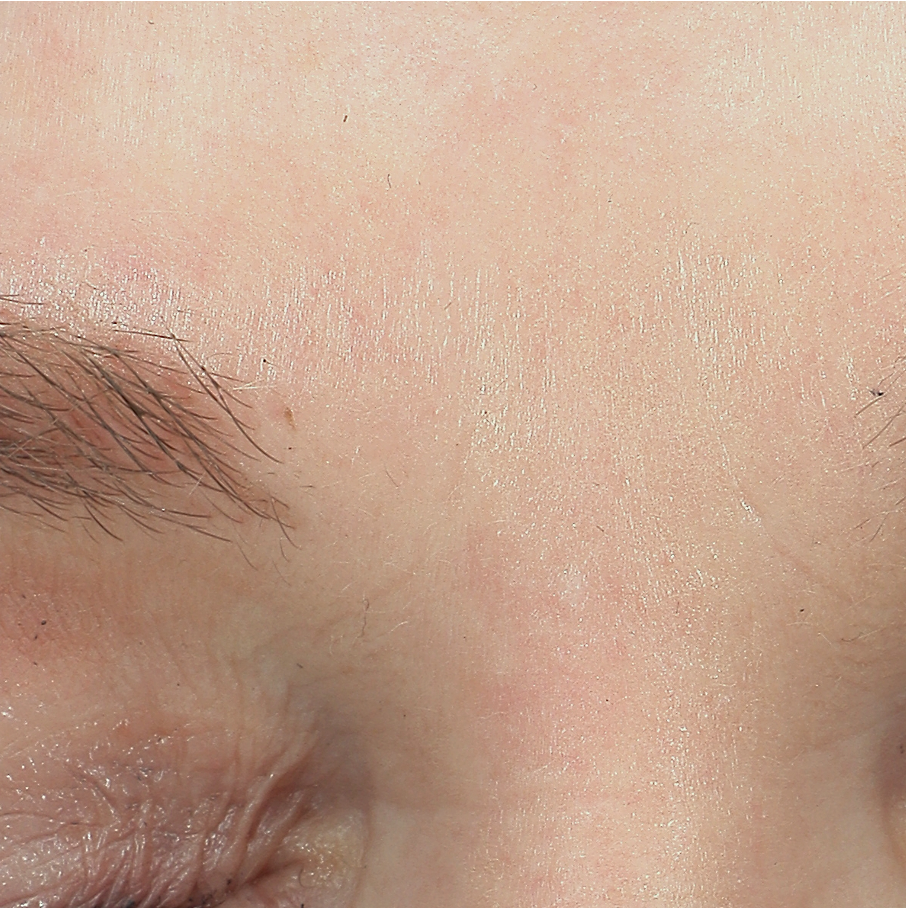 FACETOX - Pt 1 - AFTER