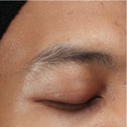FACETOX - Pt 2 - BEFORE