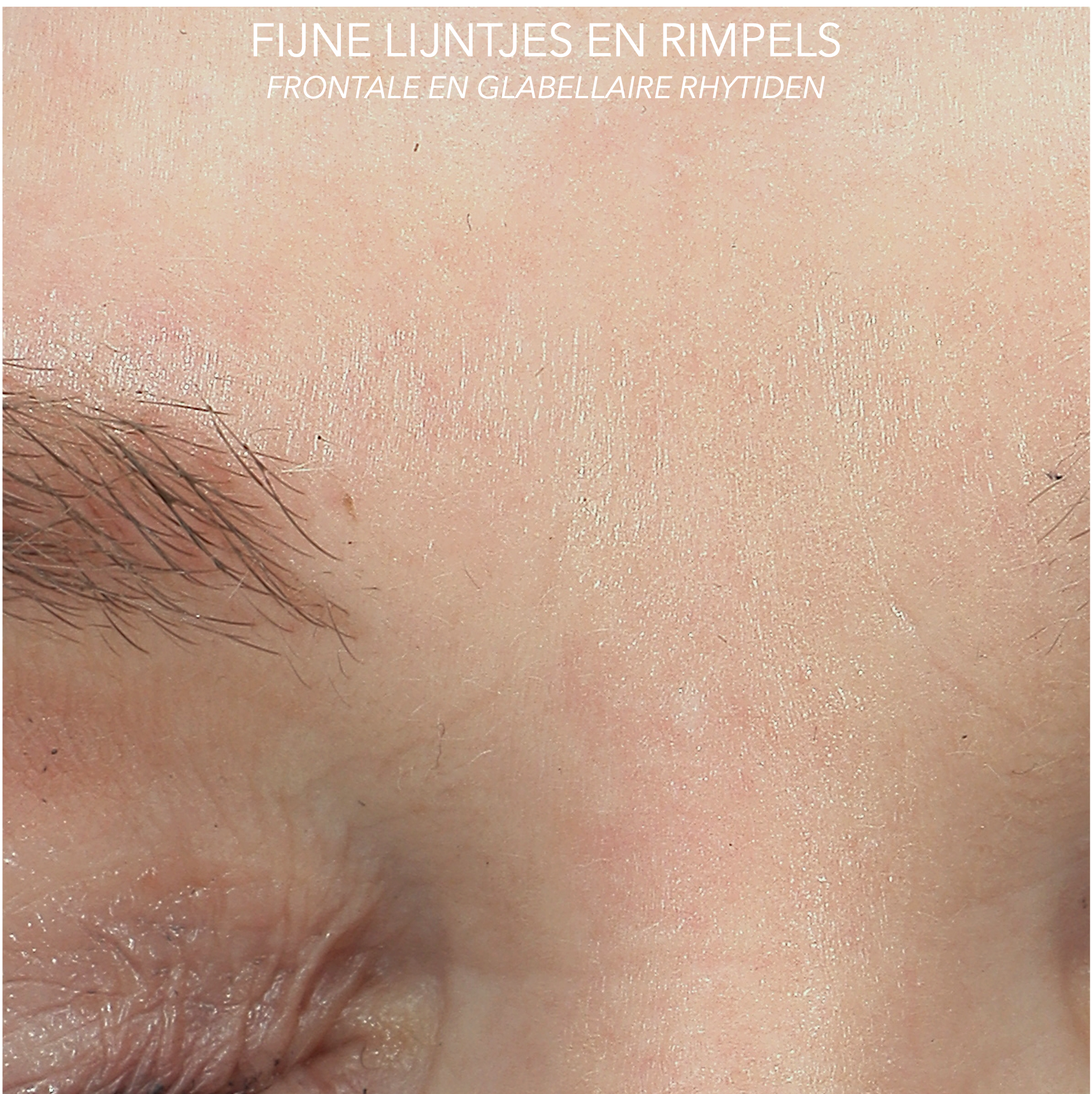 Rimpels en fijne lijntjes voorhoofd na behandeling met microtox