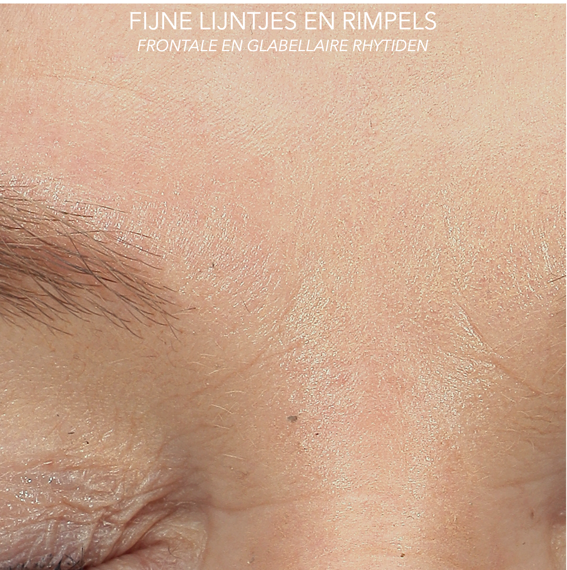 Rimpels en fijne lijntjes voorhoofd voor behandeling met microtox