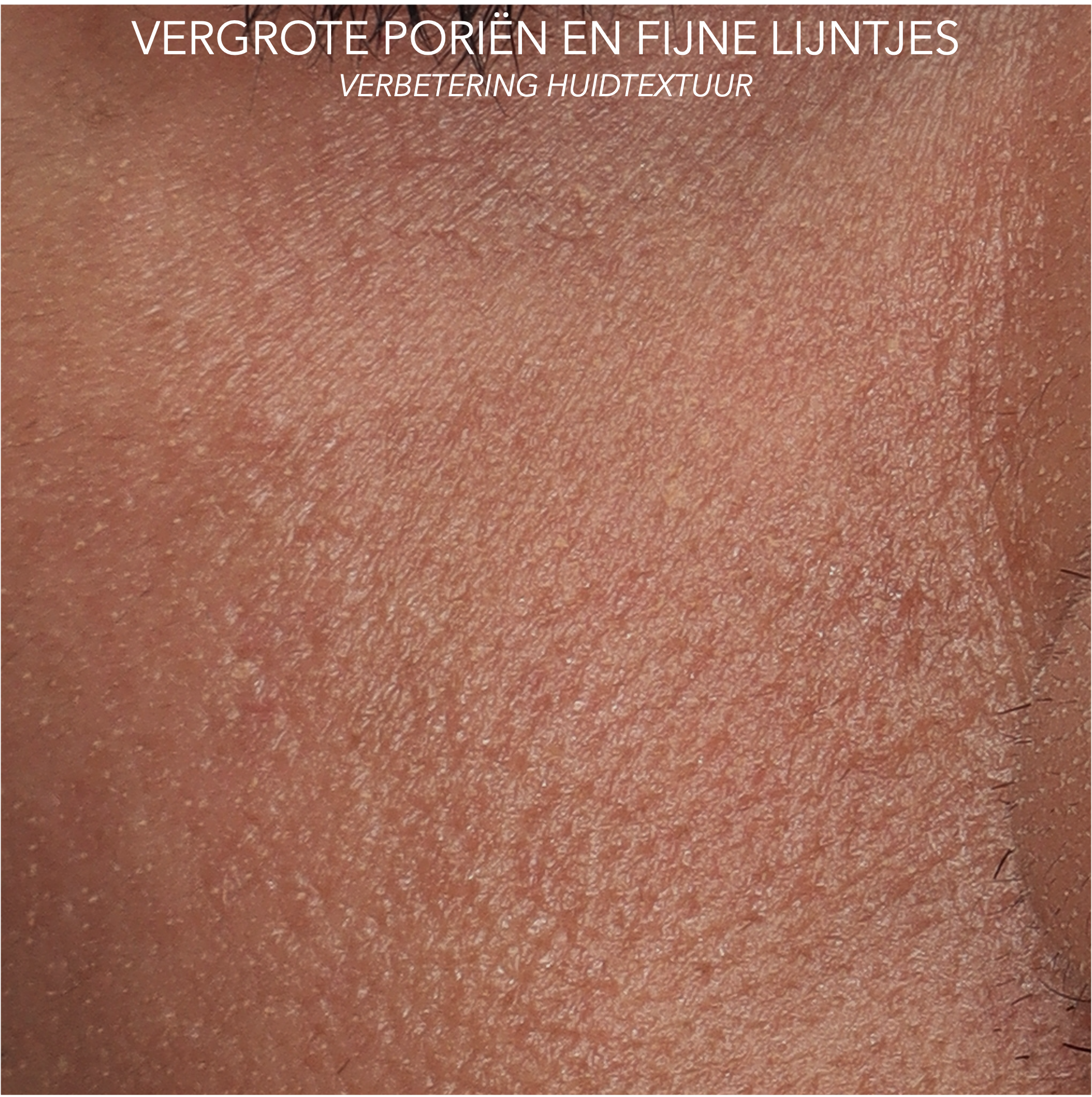 vergrote poriën en fijne lijntjes wang rechts na behandeling met microtox