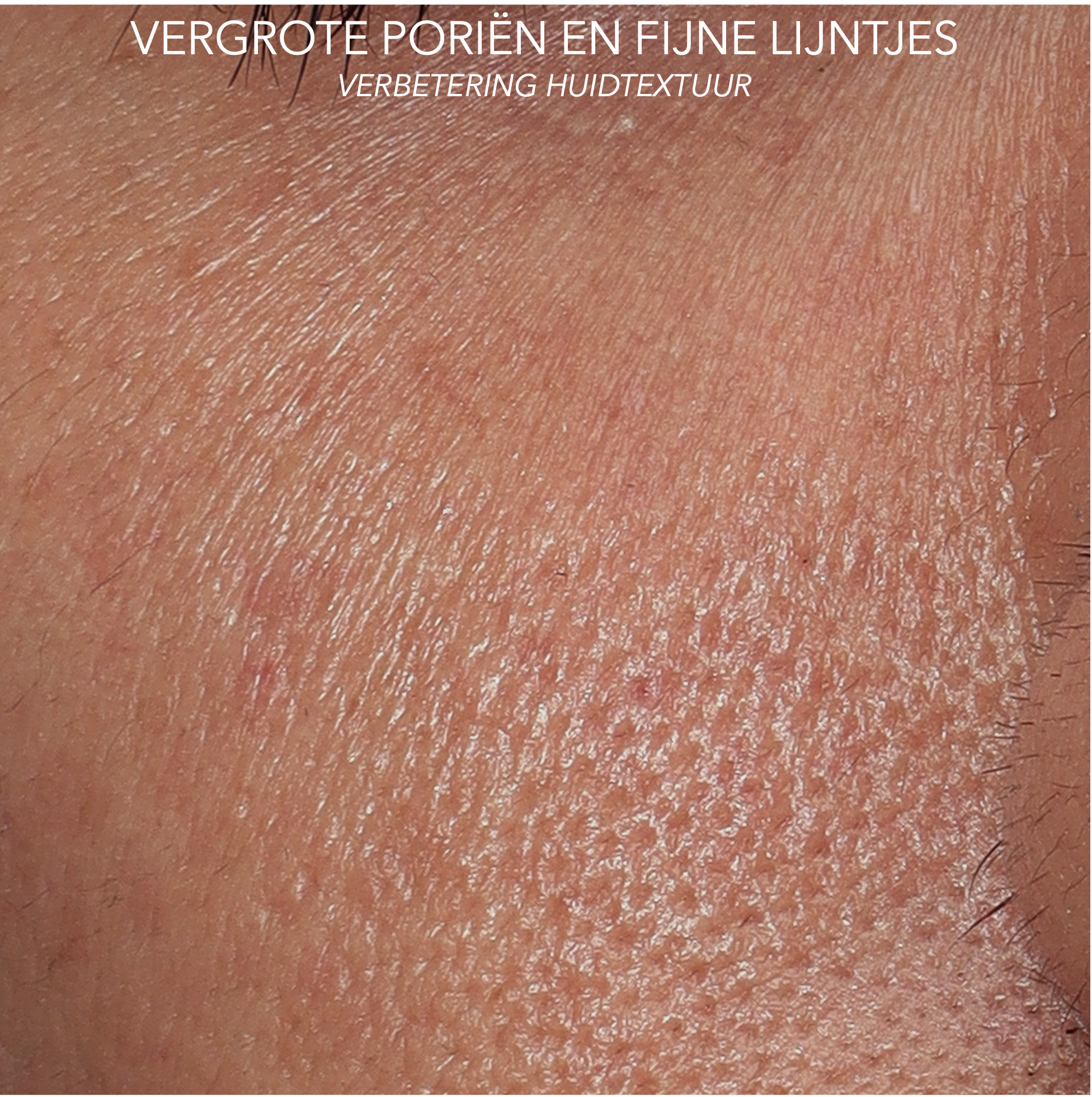 vergrote poriën en fijne lijntjes wang rechts voor behandeling met microtox
