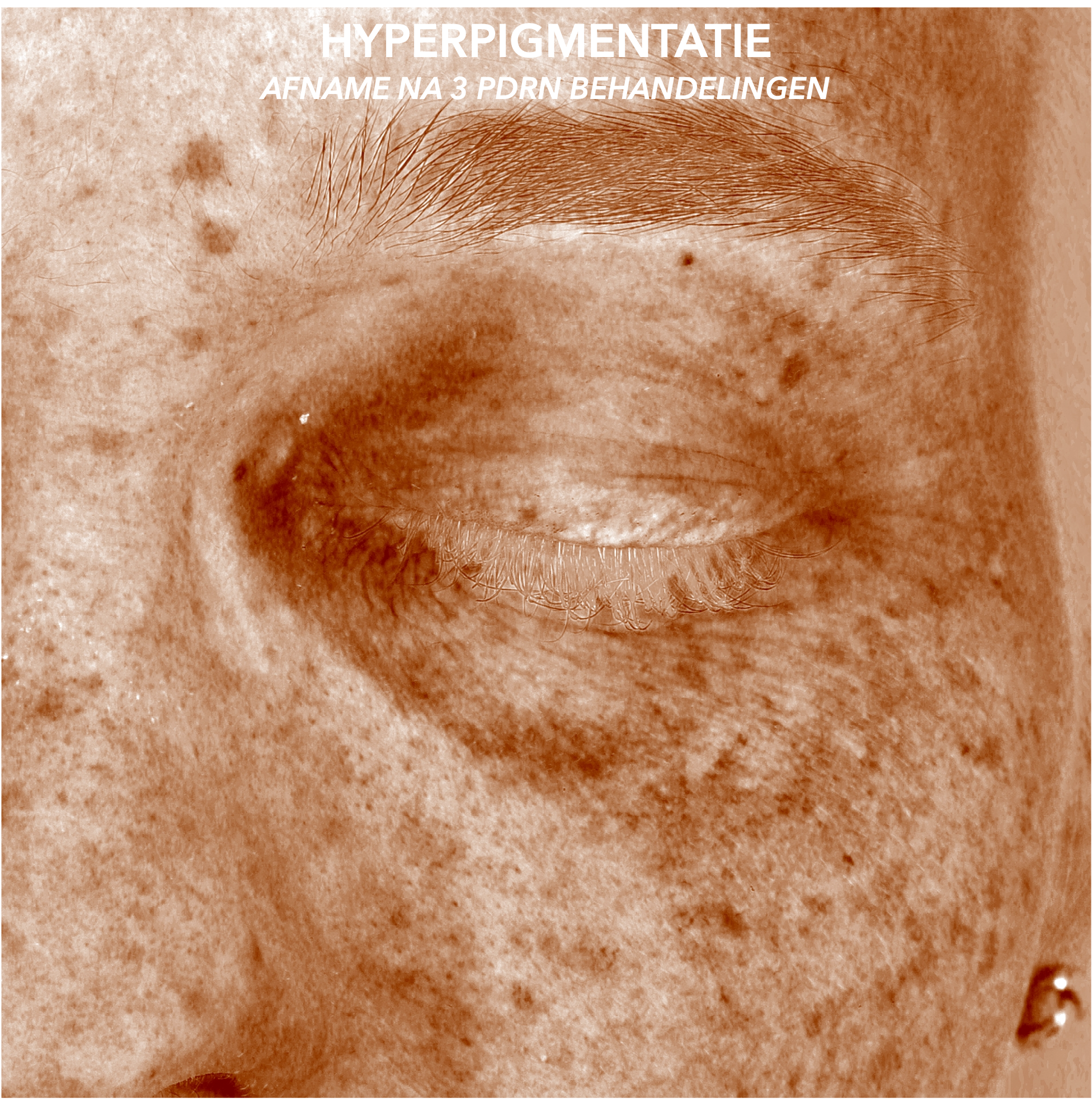 PDRN PIGMENT AFTER