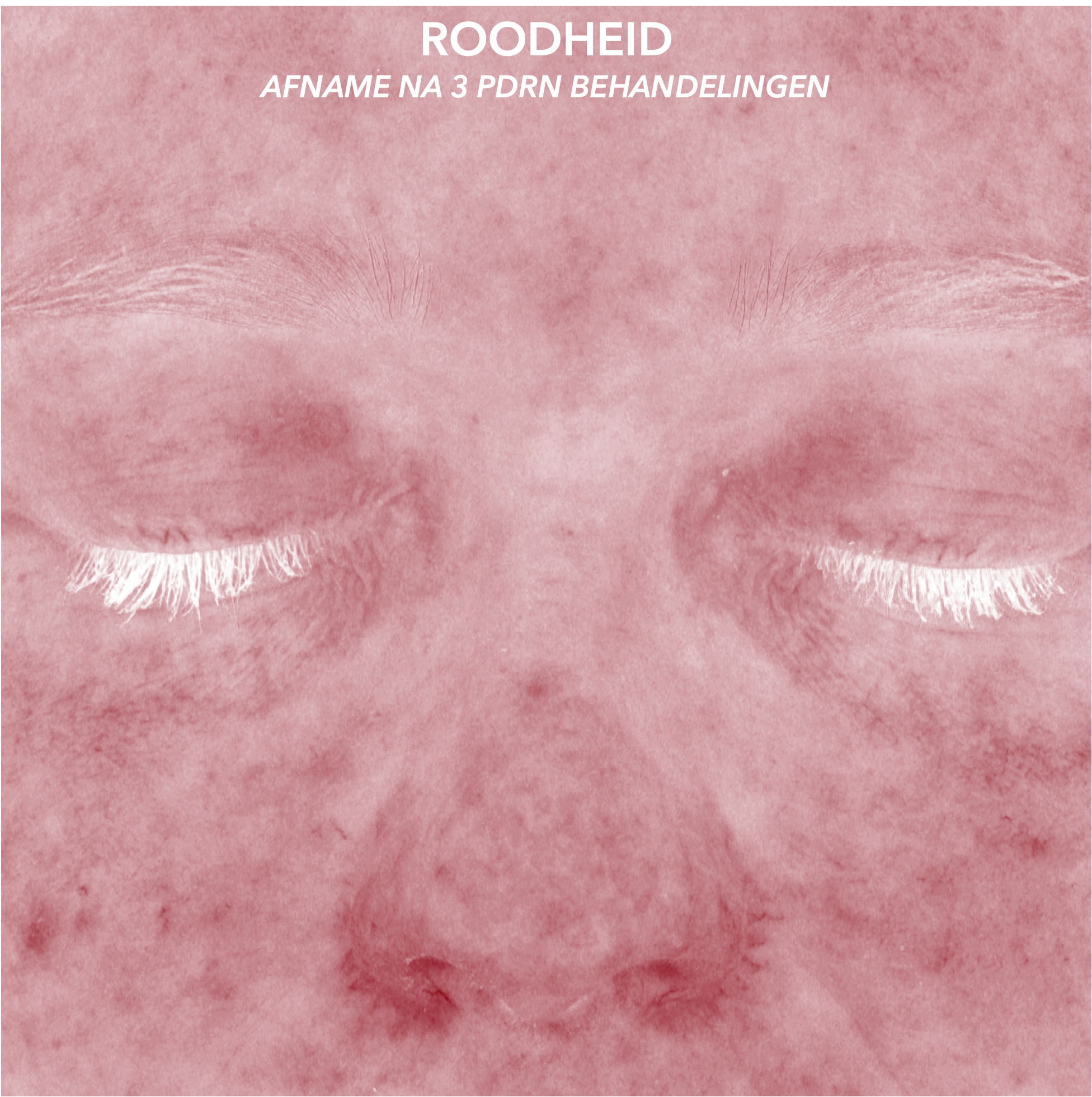 PDRN ROODHEID AFTER